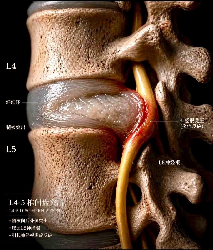 「医学科普：腰椎间盘功能性病变的5个阶段」一、 演变顺序与简单区分：1、退变 (Degeneration)椎间盘含水量减少，丧失弹性，纤维环老化