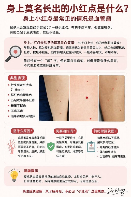「医学科普：别被“瘤”字吓到！这种小红点大多没危险」血管瘤是由于血管或淋巴管内皮细胞异常增殖引起的良性肿瘤